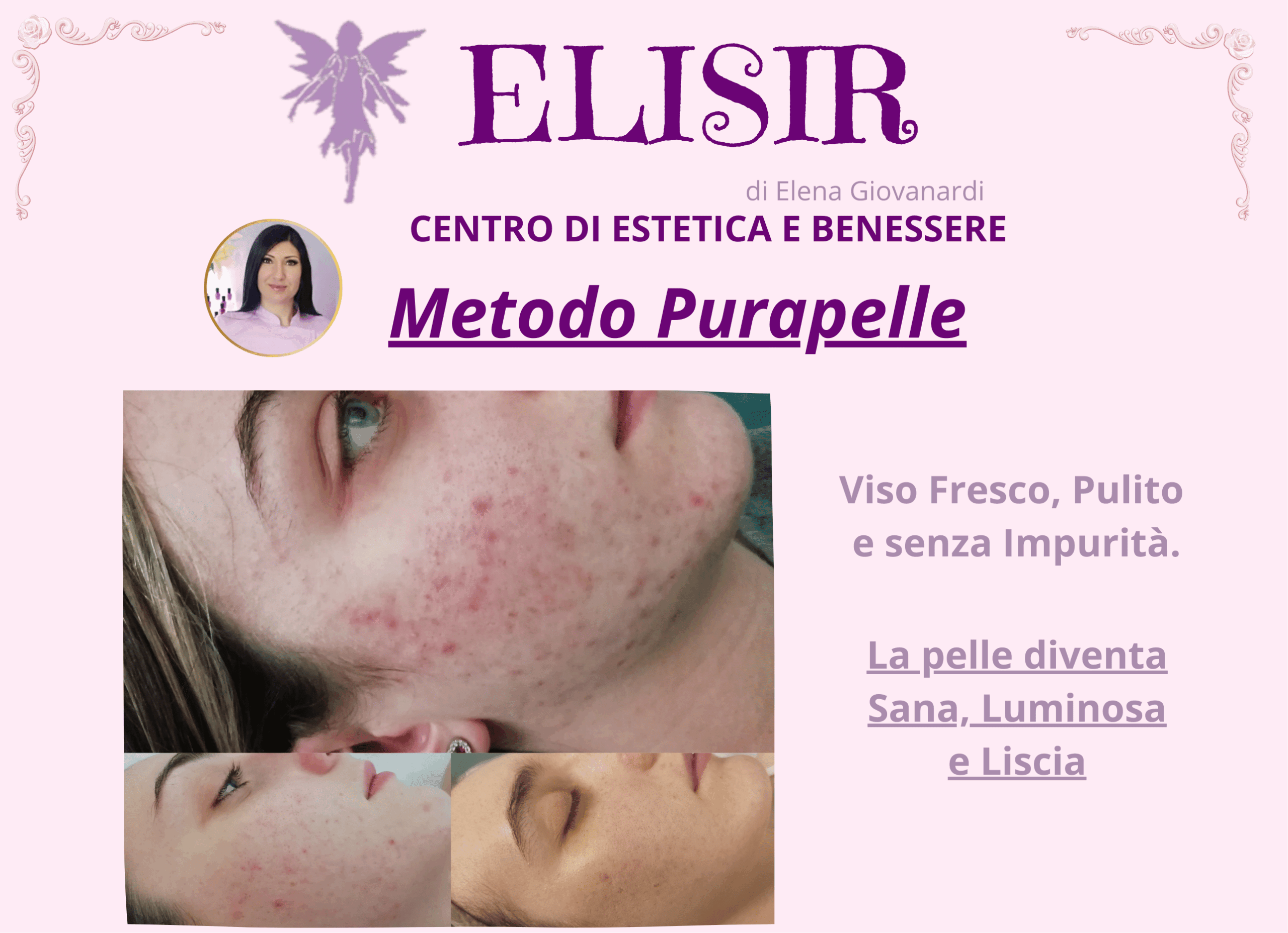 Prima e dopo trattamento acne Metodo PuraPelle® di Elisir Estetica Benessere a Roteglia